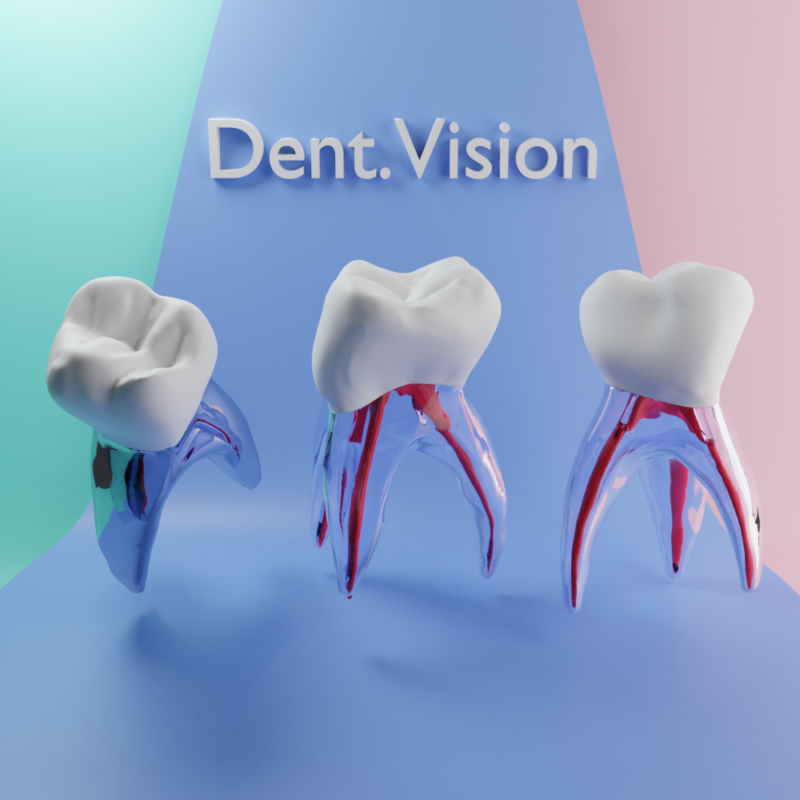 Endodontik şeffaf kanal tedavisi modeli, maxillar 1. süt molar endodontik model